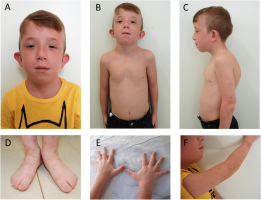 Trisomy D