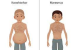 Kwashiorkor and Marasmus