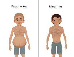 Kwashiorkor and Marasmus