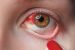 Blood Vessels in the Cornea