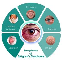 Sjögren’s syndrome