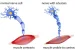 Multiple Sclerosis
