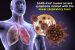 Severe Acute Respiratory Syndrome