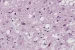 Creutzfeldt–Jakob disease causes