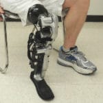 World's first 'feeling' prosthetic leg fitted in Austria