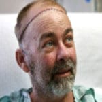 Doctors from Texas State of US successfully perform world's first skull-scalp transplant