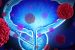 Bladder Cancer
