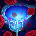 Bladder Cancer