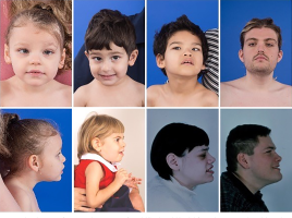 Congenital Disorder of Glycosylation