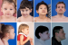 Congenital Disorder of Glycosylation