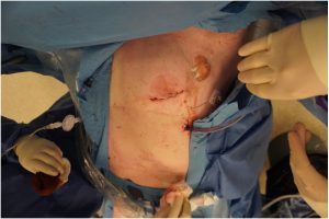 Coronary Artery Bypass Surgery