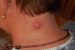 Cyst