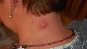 Cyst