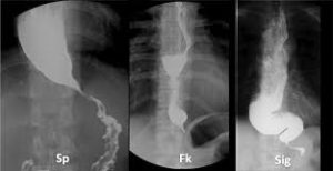 Esophageal Achalasia
