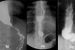 Esophageal Achalasia