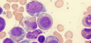 Myelodysplastic Syndrome