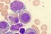 Myelodysplastic Syndrome