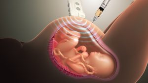 Amniocentesis