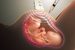Amniocentesis