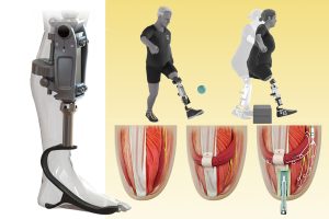Prosthesis
