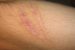 Scar