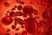 Anemia
