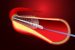 Angioplasty