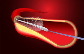 Angioplasty