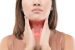 Hypothyroidism