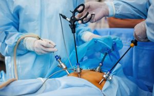 Laparoscopy