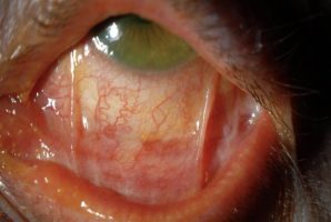 Mucous Membrane
