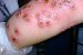Cowpox