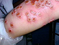 Cowpox
