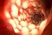 Crohns disease