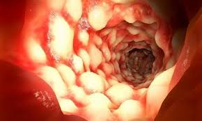 Crohns disease