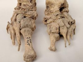 Leprosy