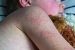 Measles