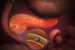 Pancreatitis
