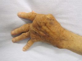 Rheumatoid arthritis