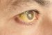Yellow fever