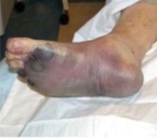 Plague disease