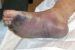Plague disease