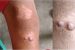 YAWS Disease