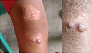 YAWS Disease