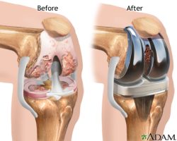 Recent Government Policy on Knee Implants