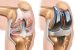 Recent Government Policy on Knee Implants