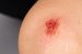 Abrasion