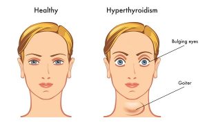 Hyperthyroidism