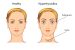 Hyperthyroidism