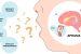 Aphasia